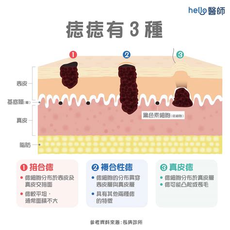 全身痣|痣形成的原因？痣長毛、痣變多變大是痣病變？5招判。